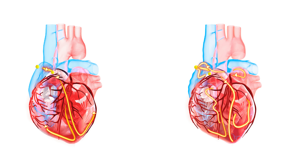 Atrial Fibrillation