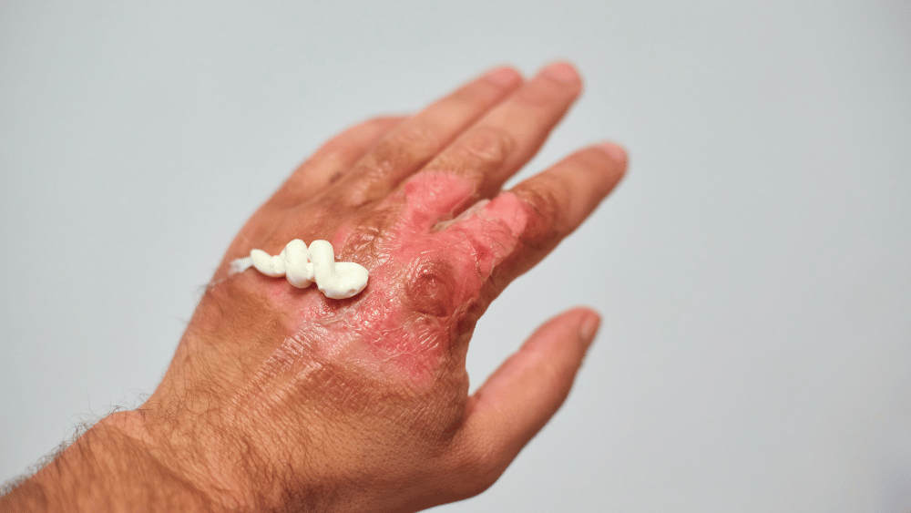 First Aid for Burns