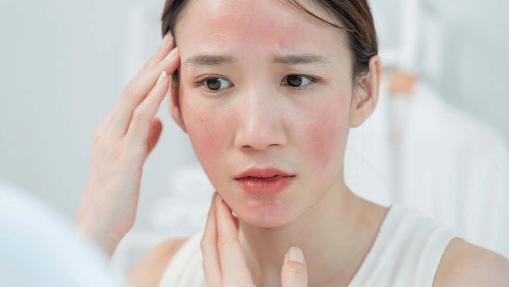 Heat Rash