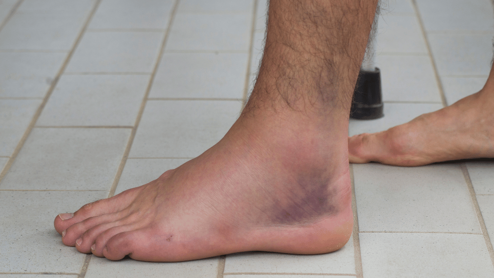 Sprained Ankles